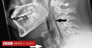 La advertencia médica después de que un hombre se perforara la garganta al intentar evitar un estornudo - BBC News Mundo