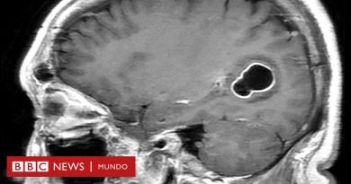 El hombre con migrañas al que médicos en EE.UU. le encontraron larvas en el cerebro por comer carne de cerdo poco cocida - BBC News Mundo