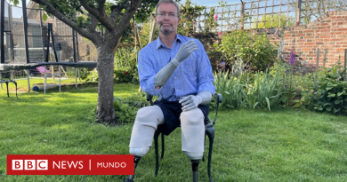 Choque séptico: “Me amputaron las manos y los pies por una sepsis