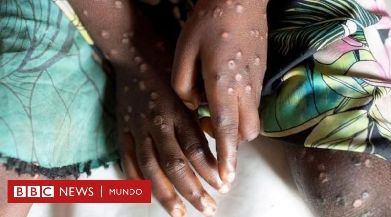 Mpox (antes viruela del mono): la infección no es una nueva covid y puede ser contenida, dice la OMS - BBC News Mundo