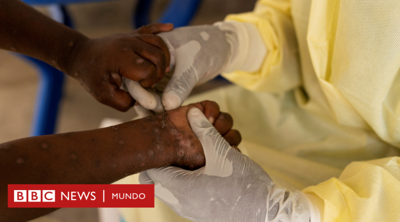 Mpox: detectan el primer caso de la nueva variante más peligrosa de la viruela símica fuera de África - BBC News Mundo