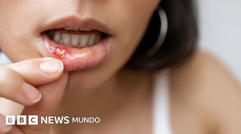 Por qué nos salen úlceras en la boca y qué puedes hacer para aliviar sus síntomas - BBC News Mundo