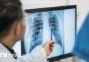 Qué es un adenocarcinoma pulmonar, el tipo de tumor maligno que le extirparon al papa León XIV - BBC News Mundo