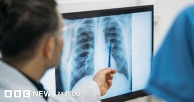 Qué es un adenocarcinoma pulmonar, el tipo de tumor maligno que le extirparon al papa León XIV - BBC News Mundo