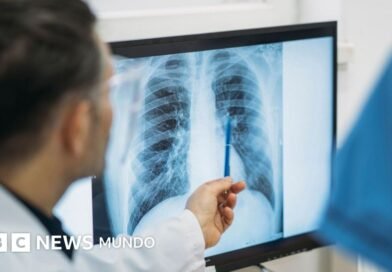 Qué es un adenocarcinoma pulmonar, el tipo de tumor maligno que le extirparon al papa León XIV - BBC News Mundo