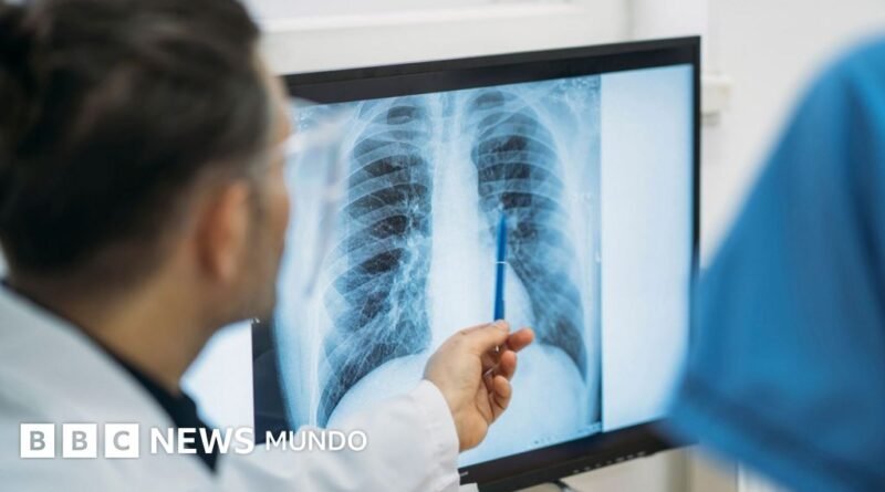 Qué es un adenocarcinoma pulmonar, el tipo de tumor maligno que le extirparon al papa León XIV - BBC News Mundo